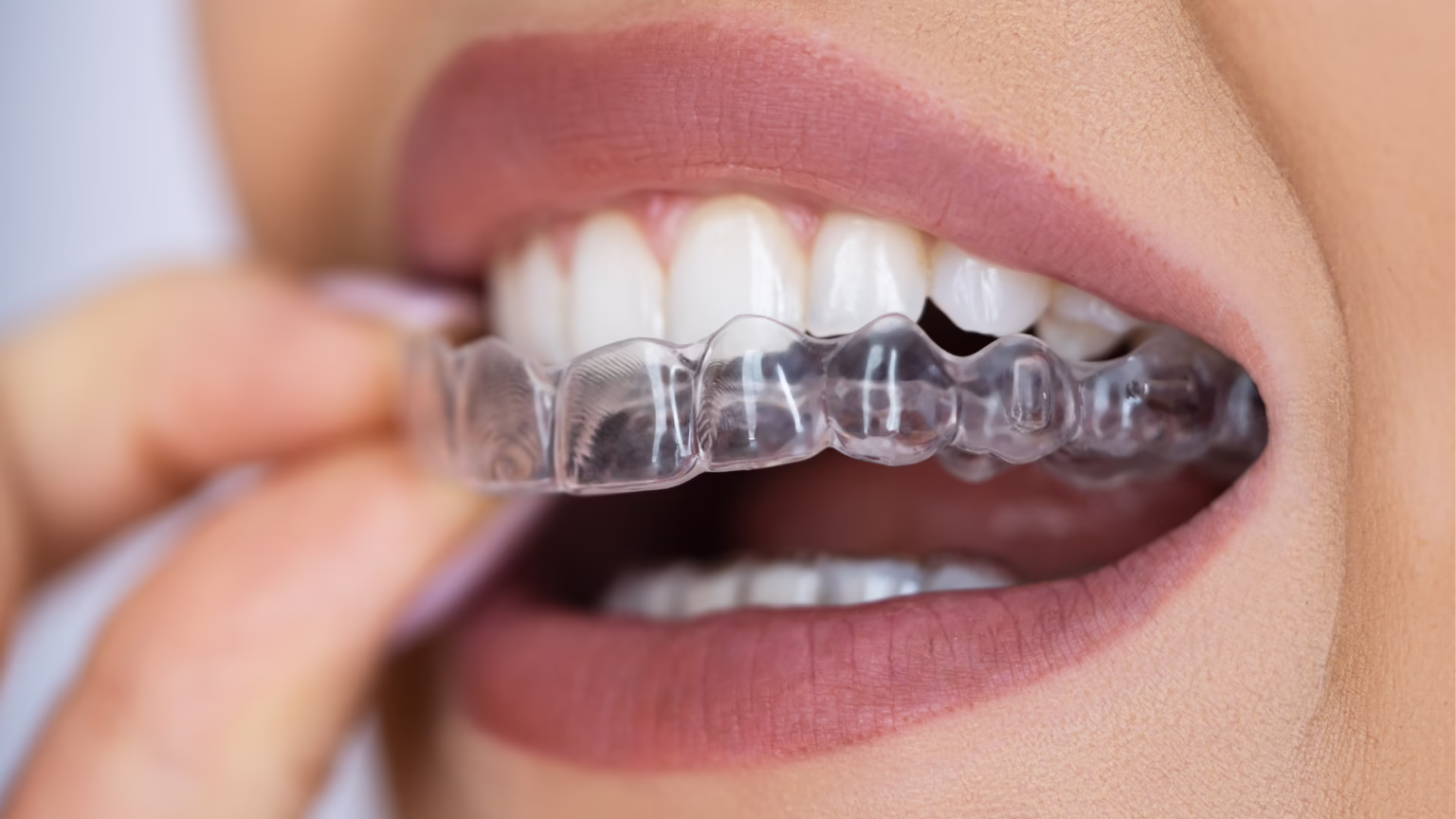 Is Invisalign Right for You? Factors to Consider Before Starting Treatment