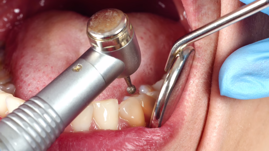 What to Expect During a Dental Filling Procedure