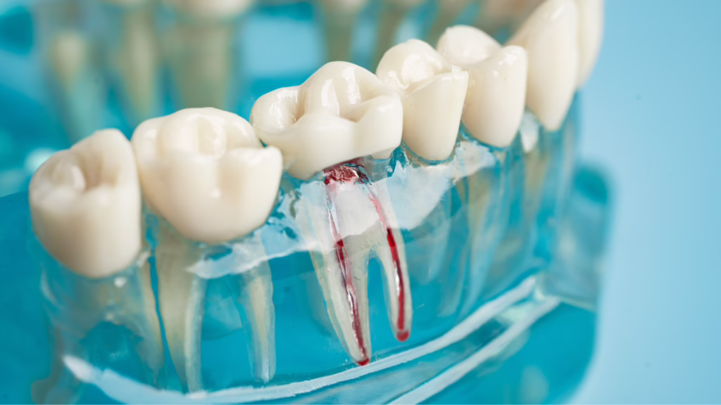 Root Canal vs. Tooth Extraction: Which Is the Better Option?